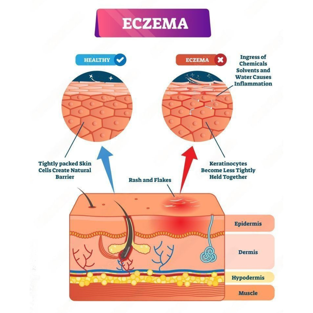 Eczema OzPure